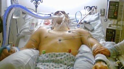 Preston Plevretes, a football player for LaSalle University, suffered a brain injury in 2005 at Duquesne University's Rooney Field so serious that doctors at UPMC Mercy had to remove part of his skull for five months. This photograph was supplied by his family.