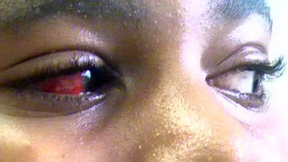 Danny is seen here four days after an incident last year in which he was physically restrained at Auberle, a juvenile facility in McKeesport. He was 12 at the time of the incident, in which his eye was injured.