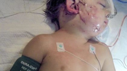 Hayden Stoll, 5, recovers in Children's Hospital of Pittsburgh of UPMC after a pit bull attacked him Friday.