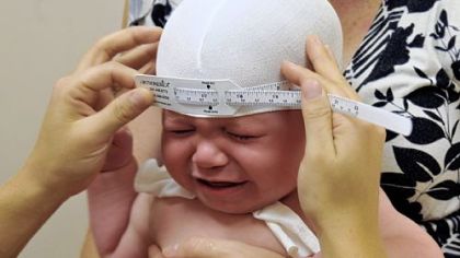 Gavin, at 6 months, has measurements of his misshapen head taken before undergoing a laser scan to create the corrective helmet at Union Orthotics & Prosthetics.